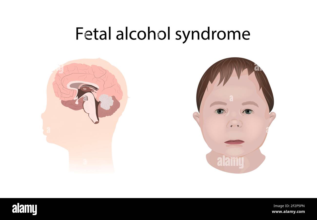 Syndrome de l'alcool fœtal, illustration Photo Stock - Alamy