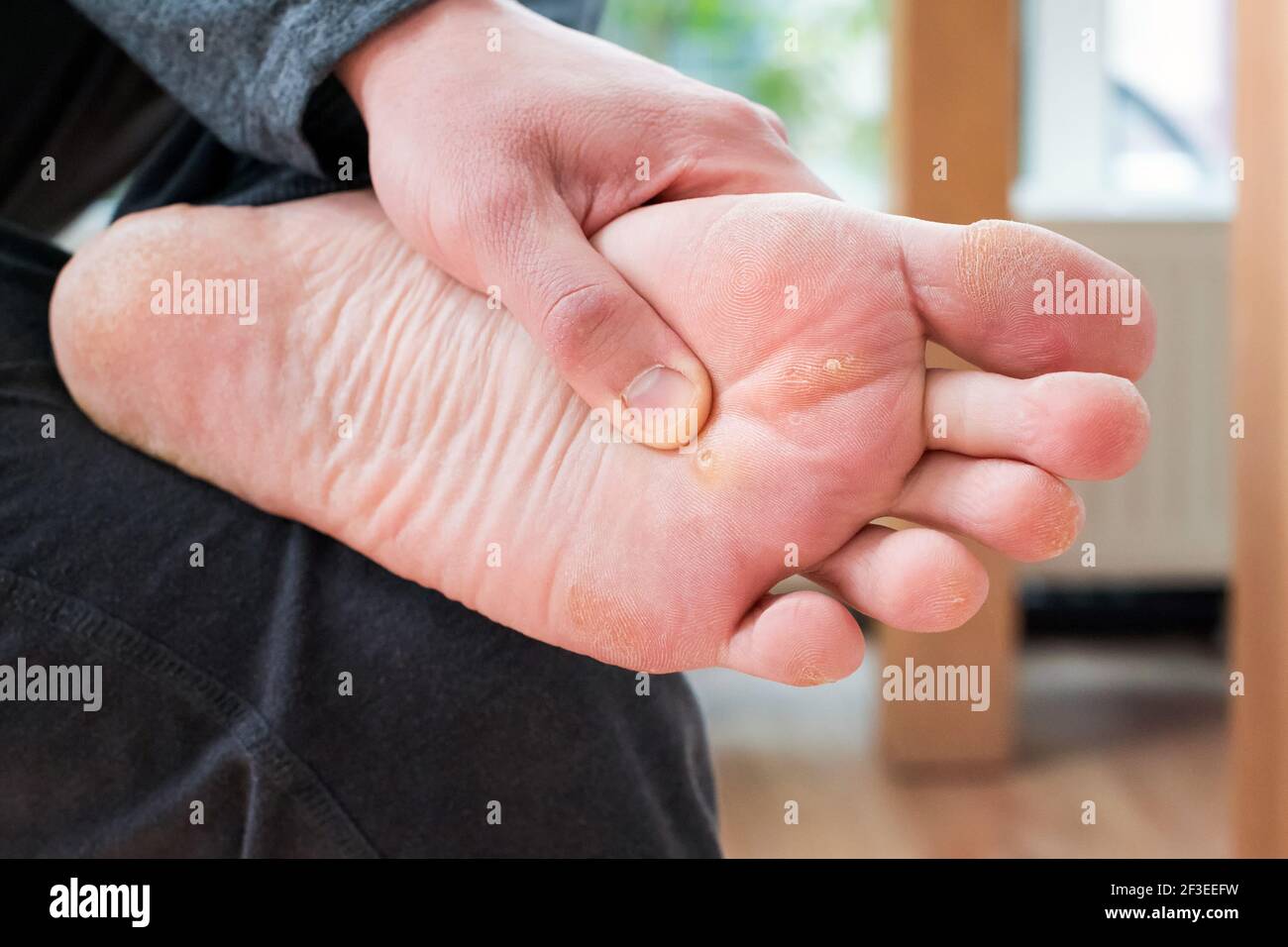 Pied avec cornes, callosités et peau sèche, verrucas plantaire verrucas verruques verruques. Virus du papillome de Verrucas, desase sur la peau du pied. Pied malsain avec du clo de maïs Banque D'Images