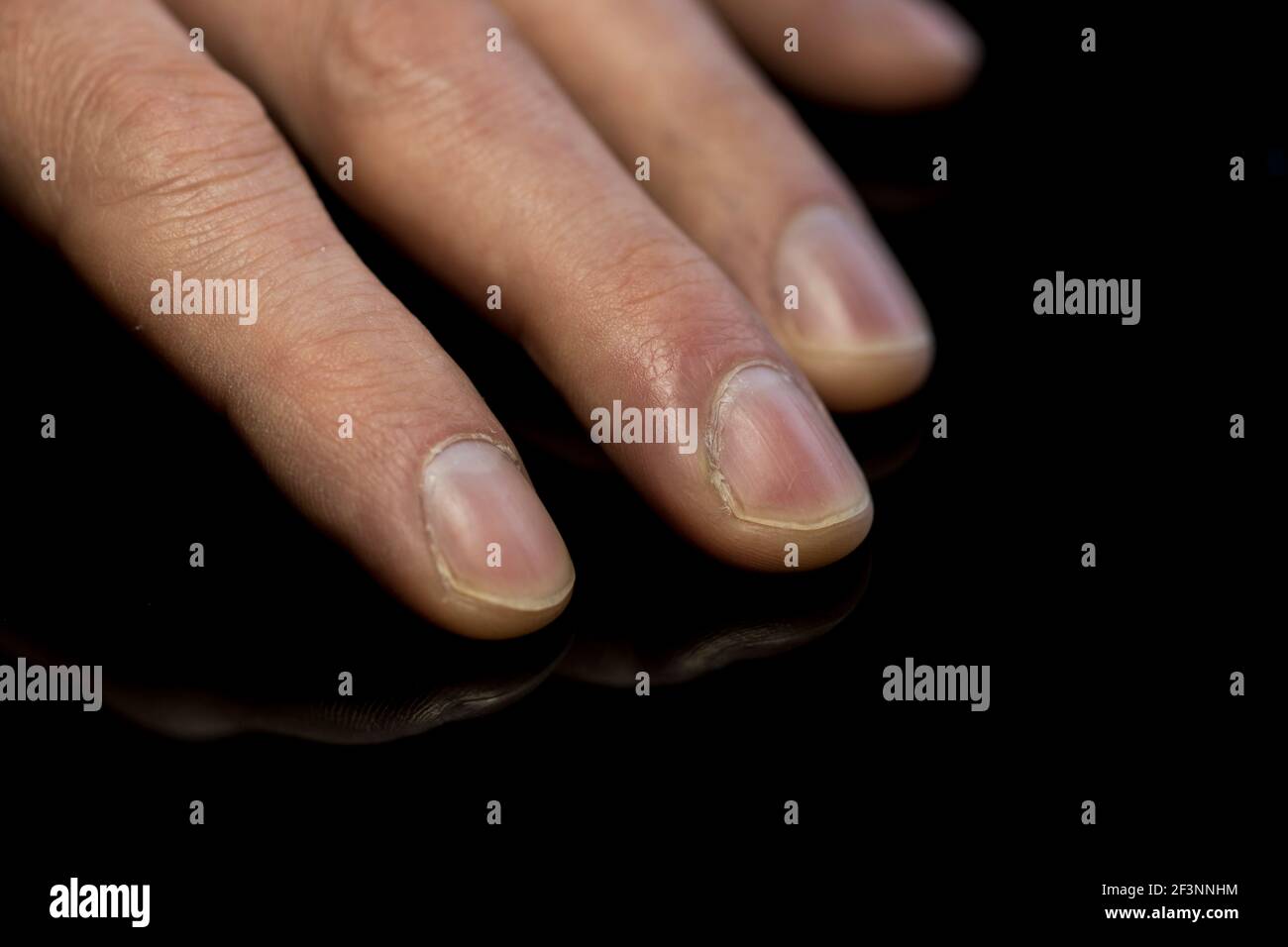 Accrocher une infection des ongles Banque de photographies et d'images à  haute résolution - Alamy