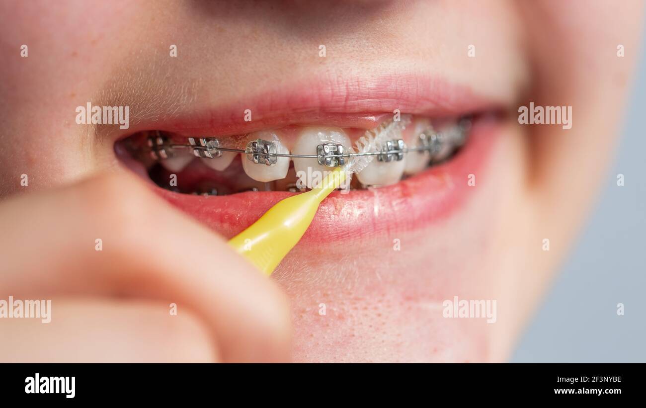 Gros plan d'une adolescente souriant entre crochets orthodontiques. Fille avec bretelles sur les dents. Traitement orthodontique. Banque D'Images