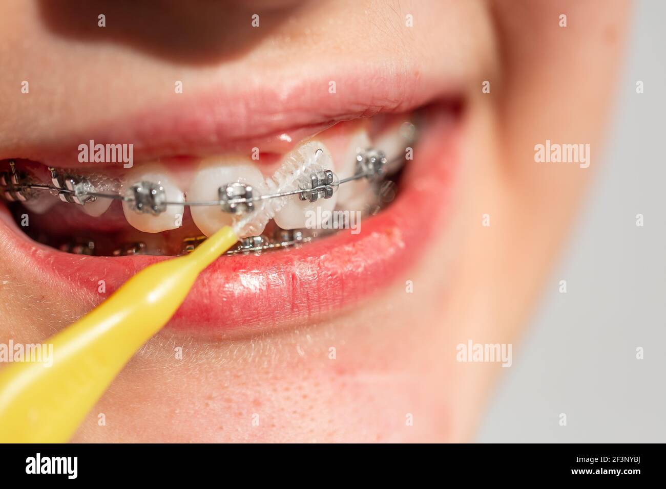 Gros plan d'une adolescente souriant entre crochets orthodontiques. Fille avec bretelles sur les dents. Traitement orthodontique. Banque D'Images