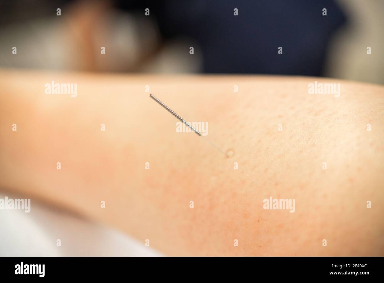 Gros plan d'une aiguille faisant une aiguille sèche dans un centre de physiothérapie. Aiguille de physiothérapeute faisant un aiguille sèche Banque D'Images