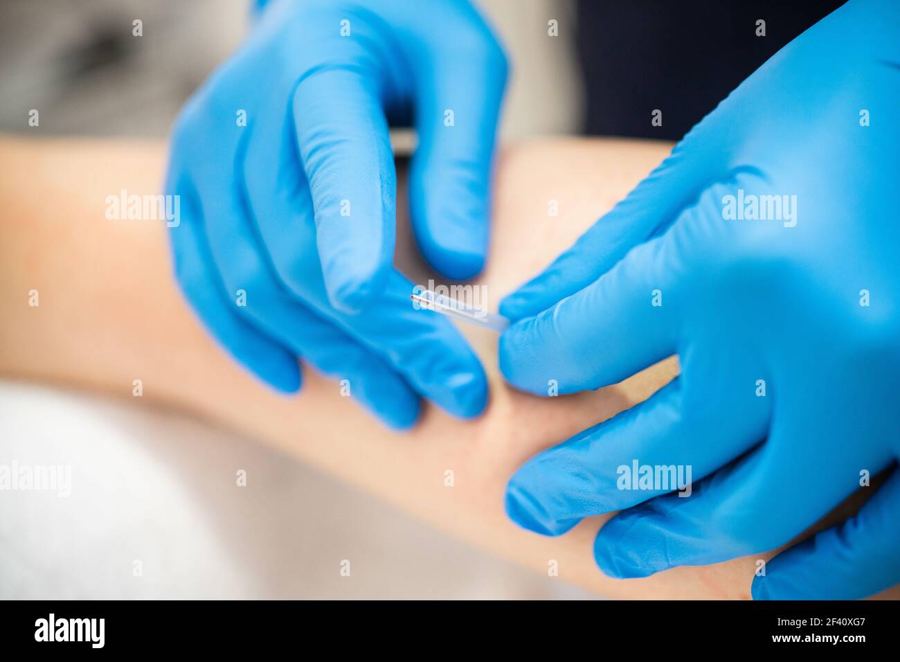 Gros plan d'une aiguille et des mains d'un physiothérapeute faisant un besoin sec dans un centre de physiothérapie. Mains du physiothérapeute faisant un aiguilles sec Banque D'Images