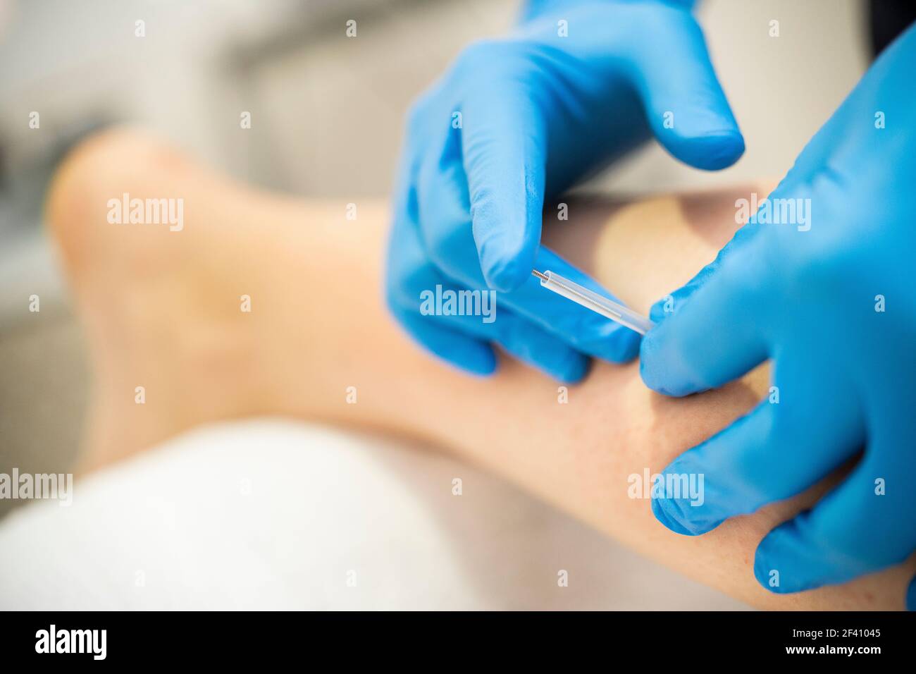 Gros plan d'une aiguille et des mains d'un physiothérapeute faisant un besoin sec dans un centre de physiothérapie. Mains du physiothérapeute faisant un aiguilles sec Banque D'Images