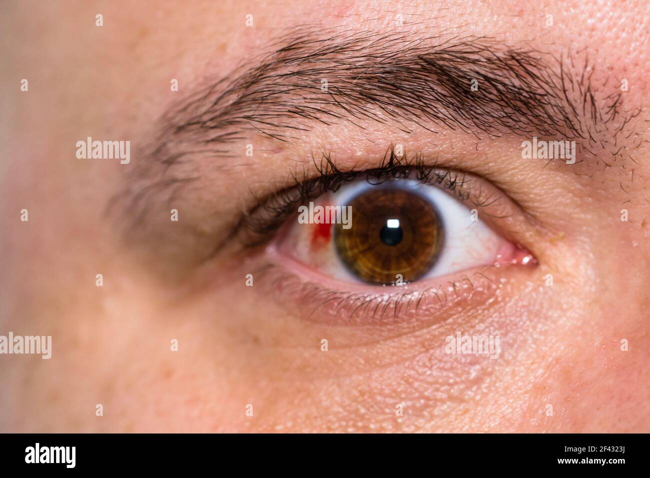 Eclatement Du Vaisseau Sanguin Banque D Image Et Photos Alamy