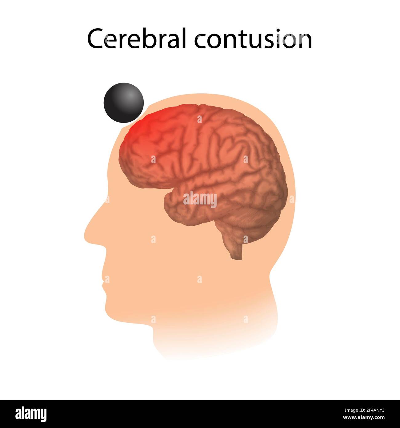 Contusion cérébrale, illustration Banque D'Images