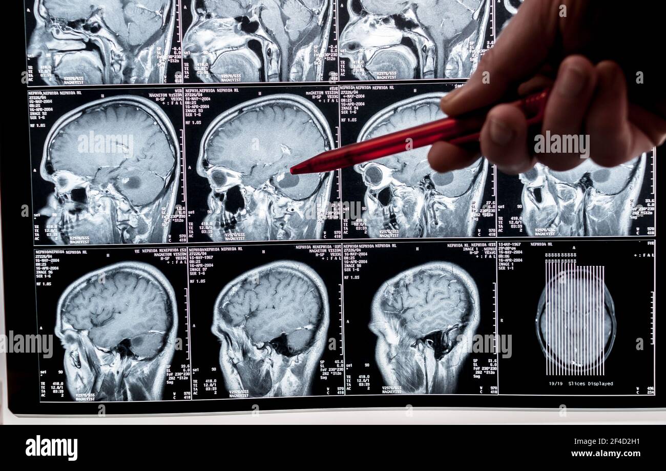 Image rare d'une tumeur du cerveau. Image d'imagerie par résonance magnétique. Tête illustrée en profil. Banque D'Images