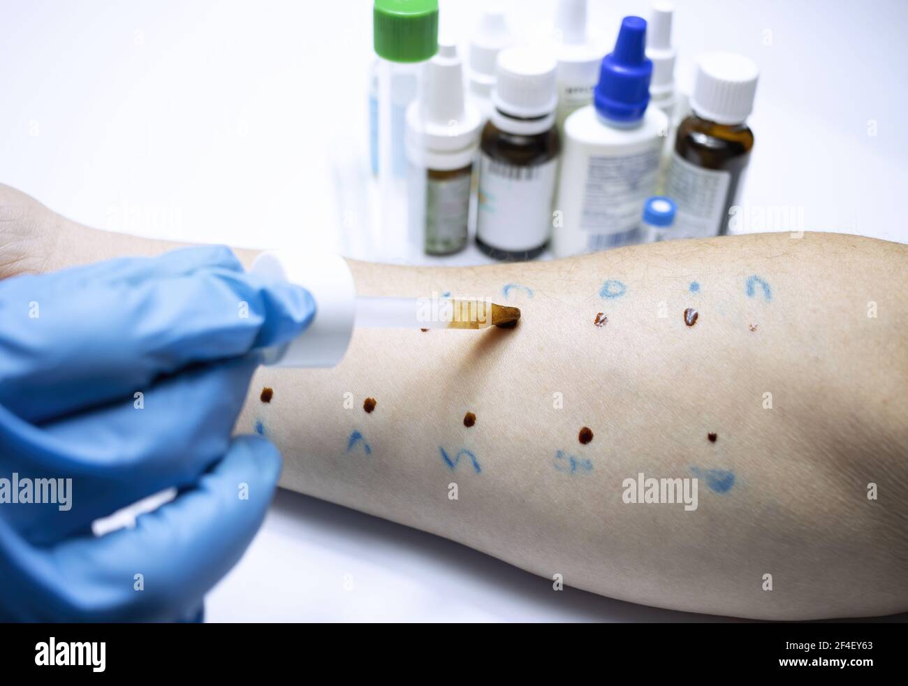 a effectué un test d'allergie dans un avant-bras Banque D'Images
