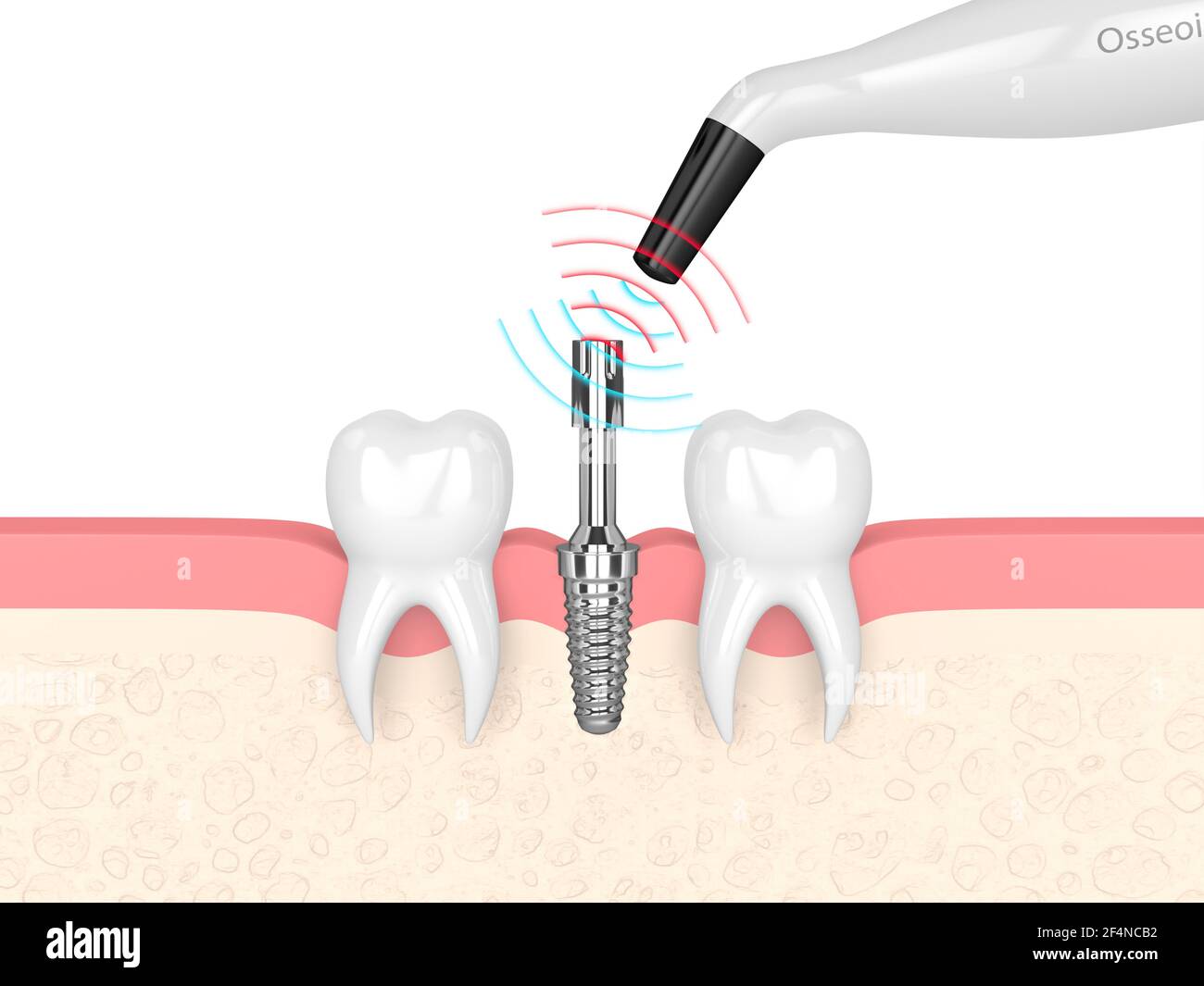rendu 3d du dispositif de surveillance de l'osmointégration vérifiant la stabilité de l'implant dentaire Banque D'Images