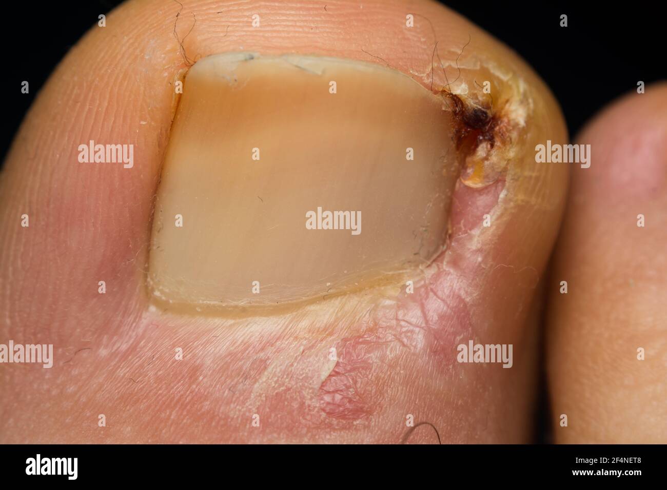 photo de gros plan d'une infection à la caille chez l'homme Banque D'Images
