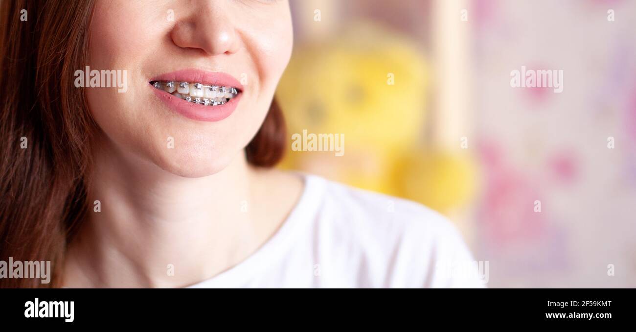 Le sourire d'une jeune fille avec des bretelles sur ses dents blanches. Redressage des dents. Banque D'Images