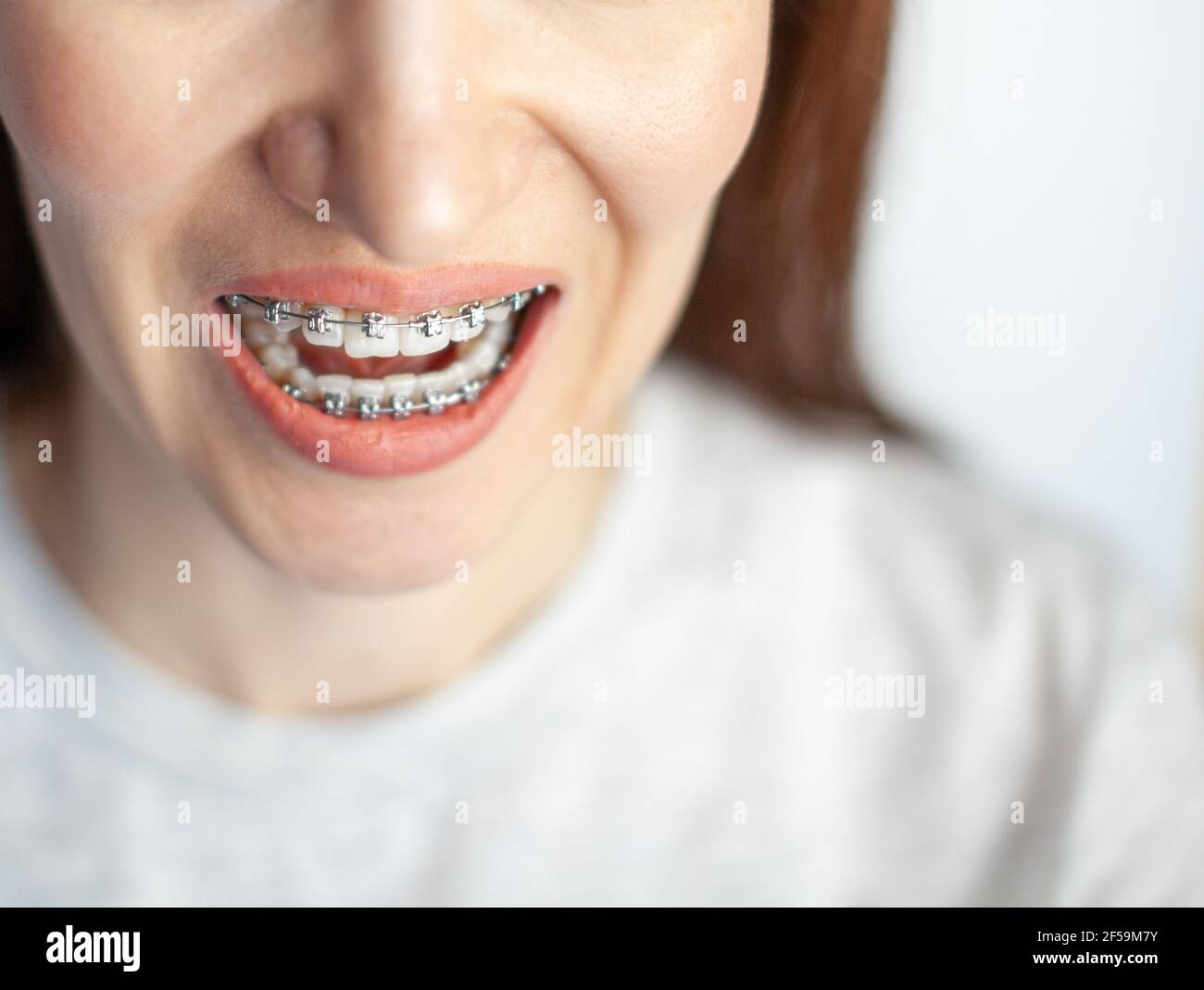 Le sourire d'une jeune fille avec des bretelles sur ses dents blanches. Redressage des dents. Banque D'Images