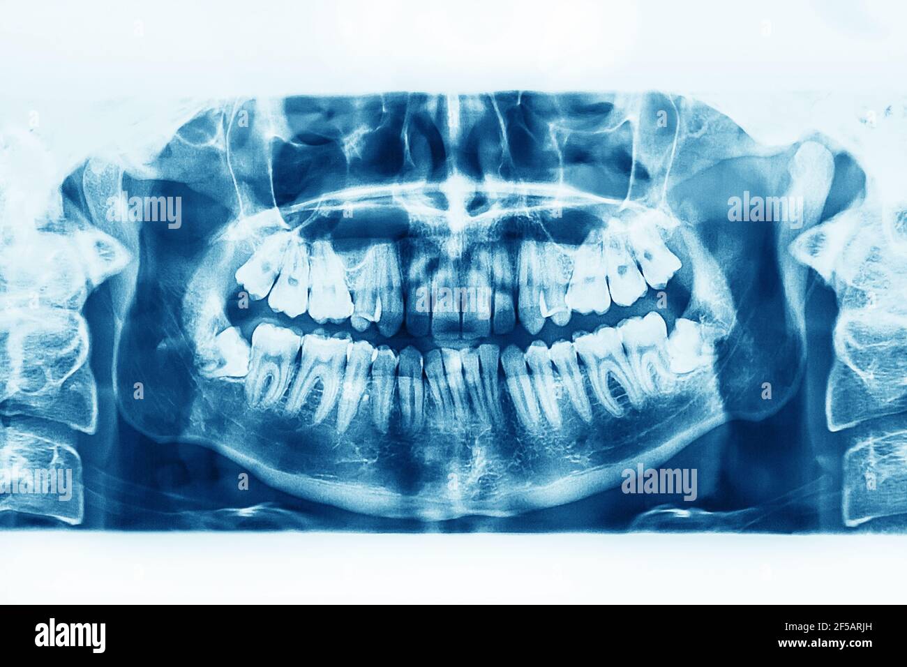 Image radiographique de la cavité buccale avec des dents plus petites sur fond blanc. Banque D'Images