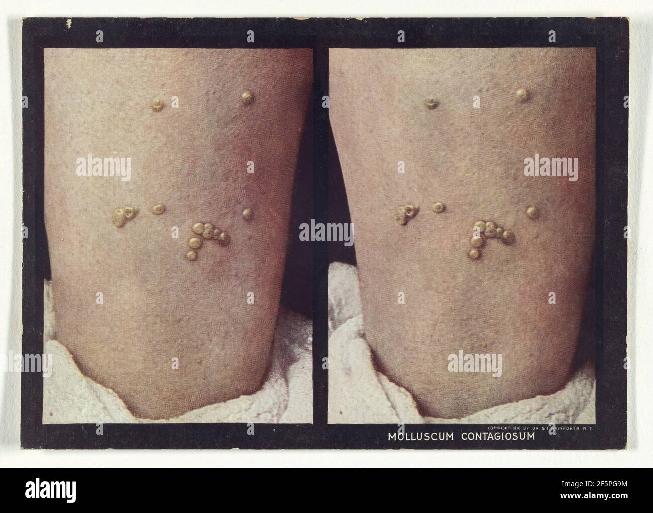 Molluskum Contagiosum. Dr Selden I. Rainforth (américain, 1879 - 1960) Banque D'Images