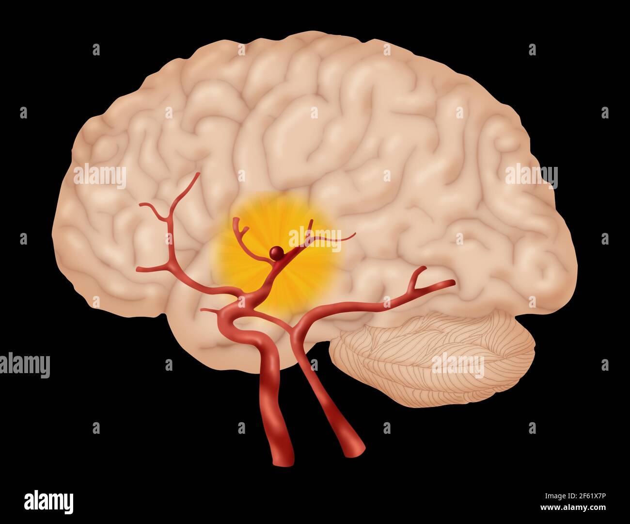 Anévrisme cérébral, 2 de 3 Banque D'Images