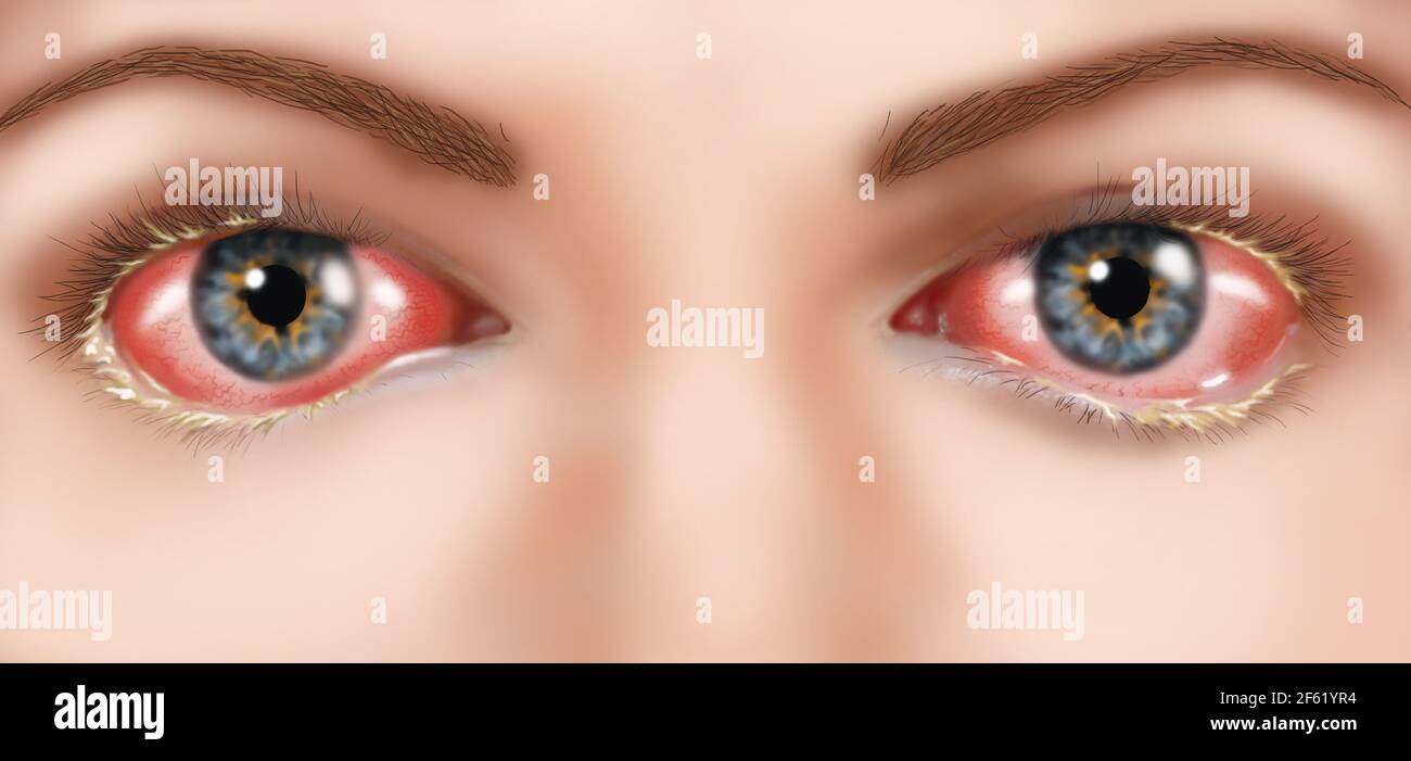 Conjonctivite Banque D'Images