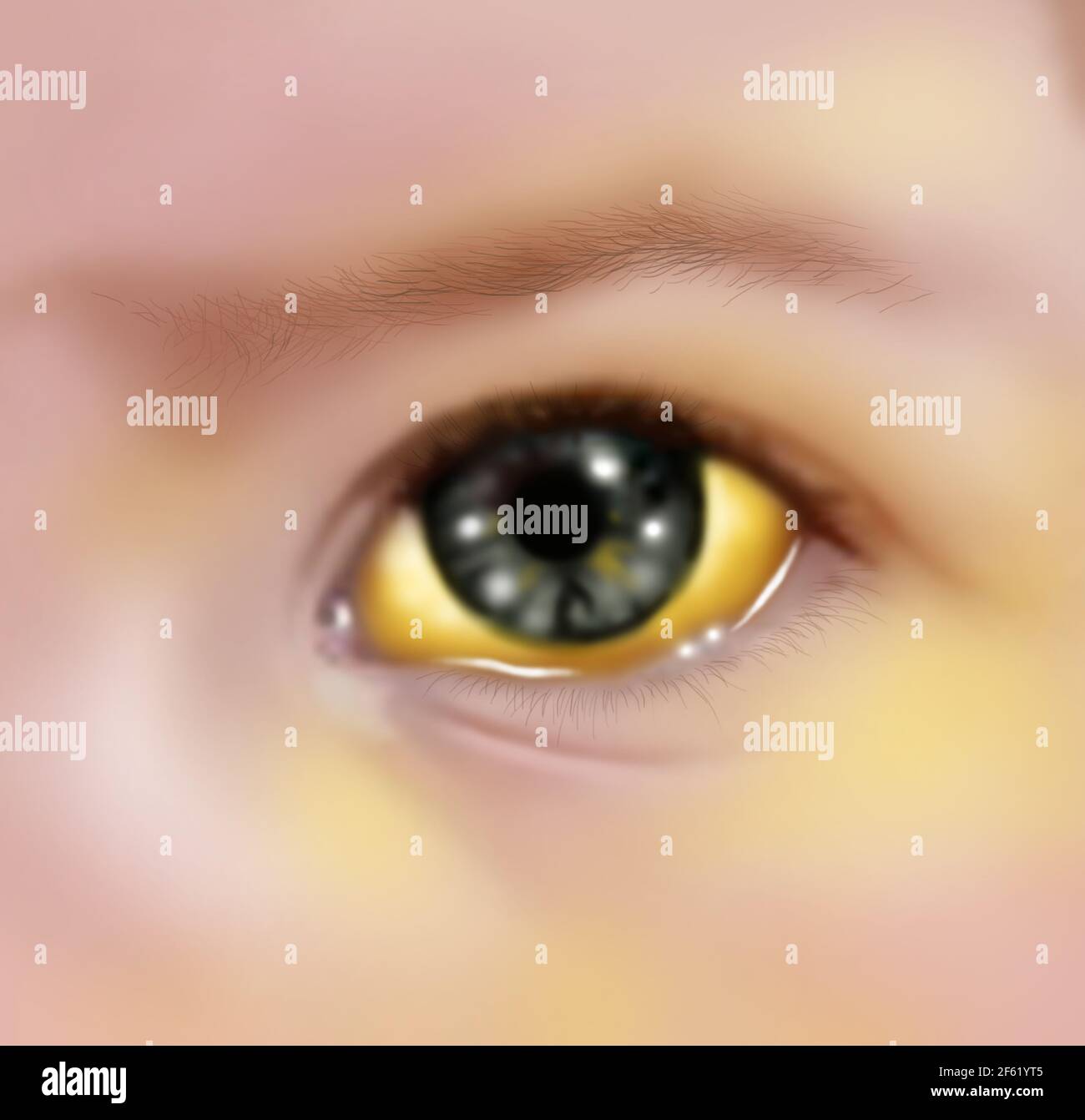 Jaundice Eye Banque D Image Et Photos Alamy Jaundice Eye Banque D Image Et Photos Alamy