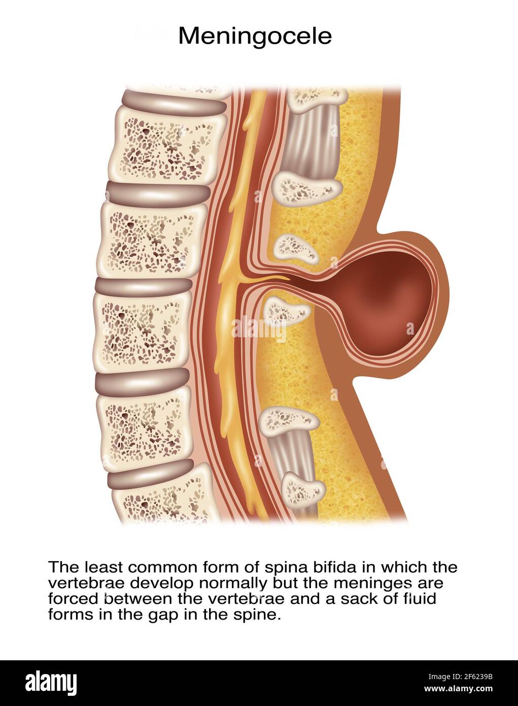 Spina meningiocele, Illustration Banque D'Images