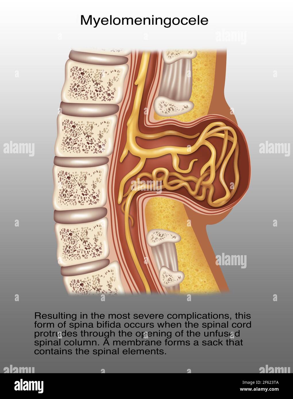 Spina myélomeningocele, Illustration Banque D'Images