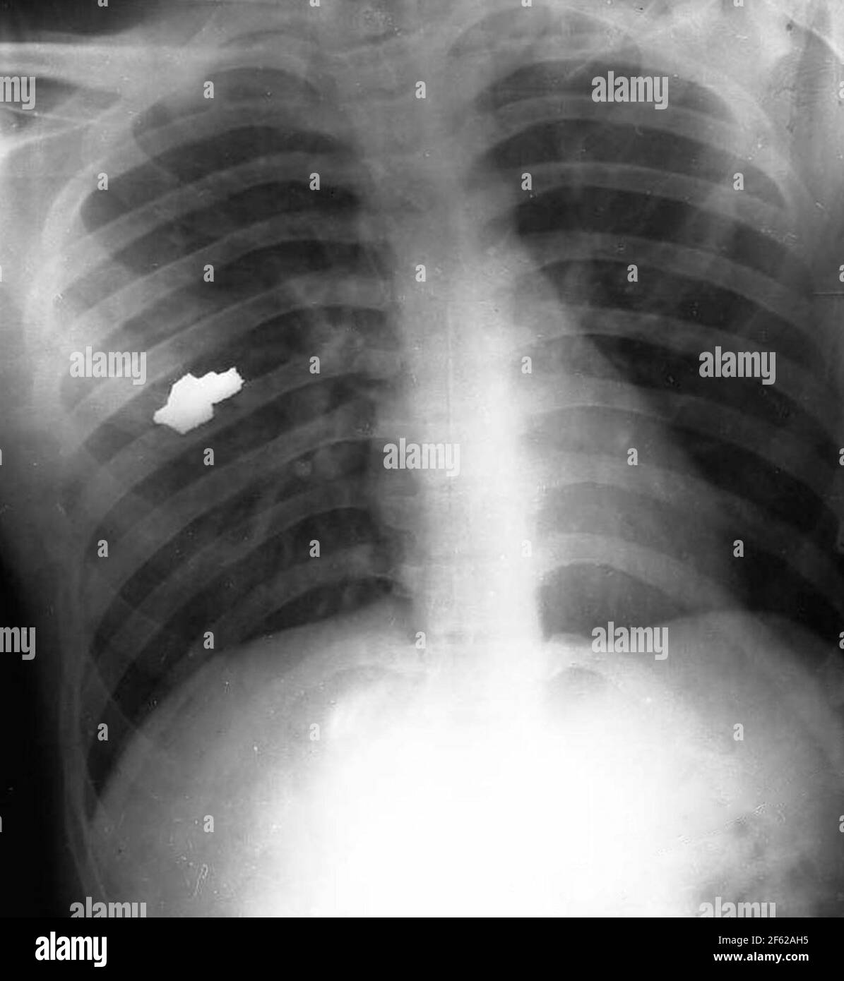 Bullet in Chest, X-Ray, la guerre de Corée Banque D'Images