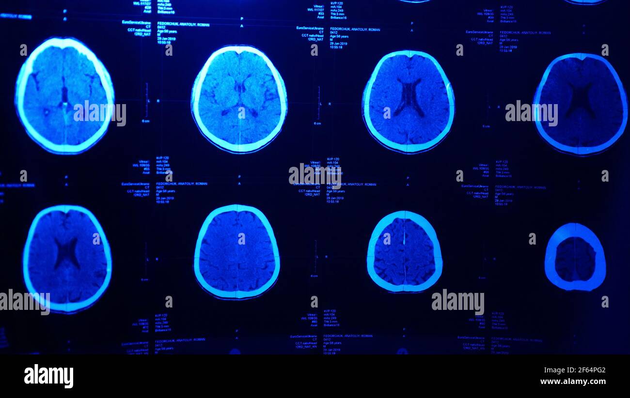 Cette photo montre une IRM du cerveau par résonance magnétique après une lésion cérébrale traumatique, montrant que le cerveau est endommagé Banque D'Images