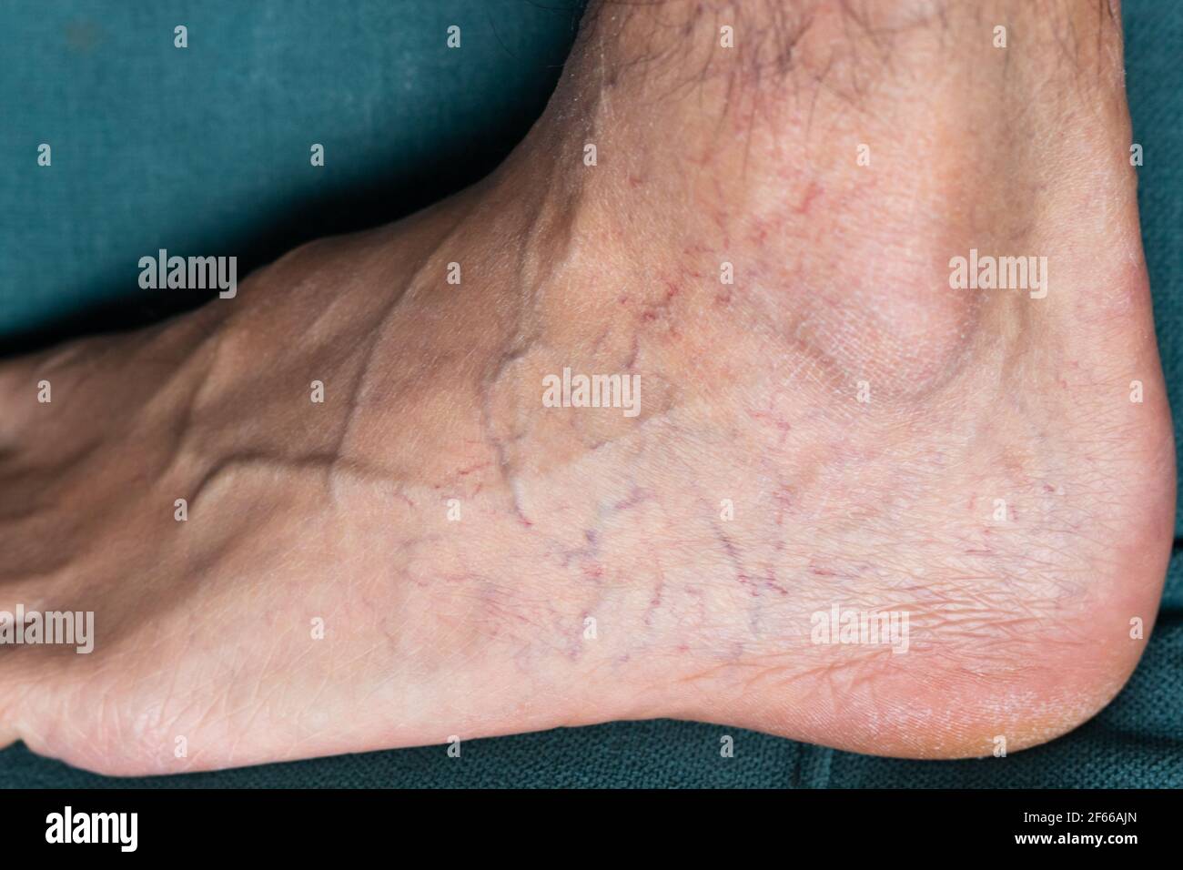 Pied d'homme adulte avec varices Banque D'Images