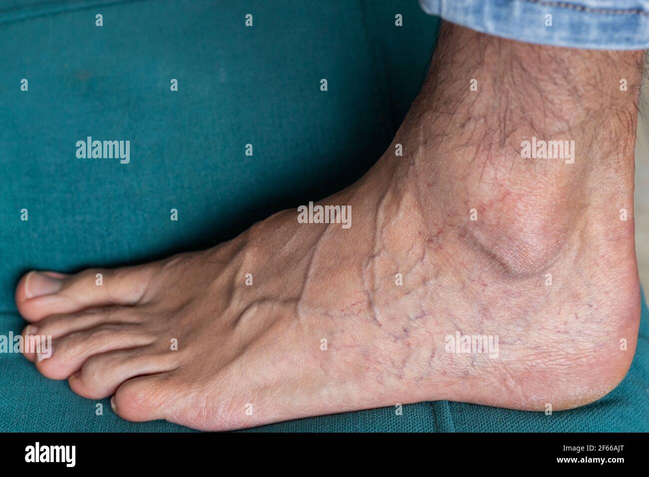 Pied d'homme adulte avec varices Banque D'Images