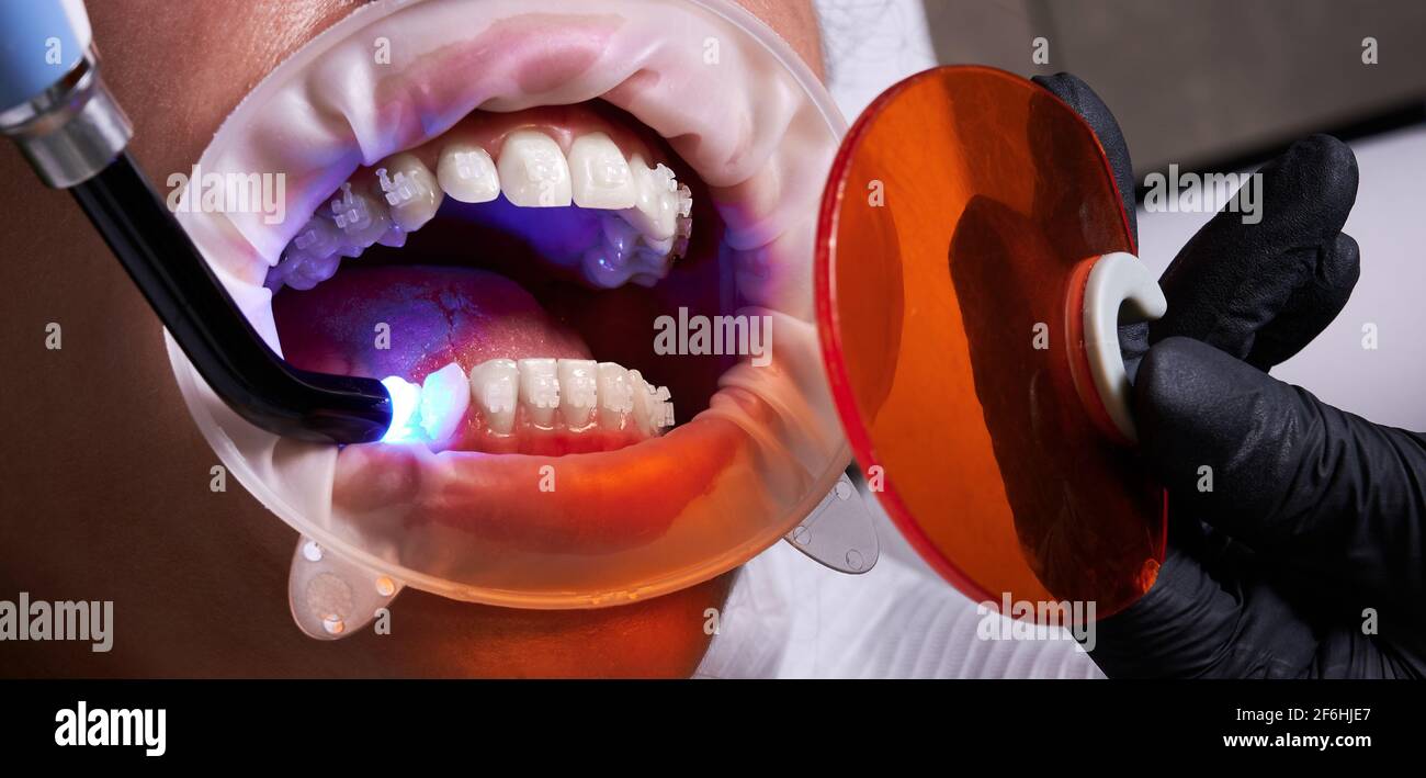 Processus de fixation des entretoises en céramique aux dents avec un à  l'aide de la colle uv Photo Stock - Alamy