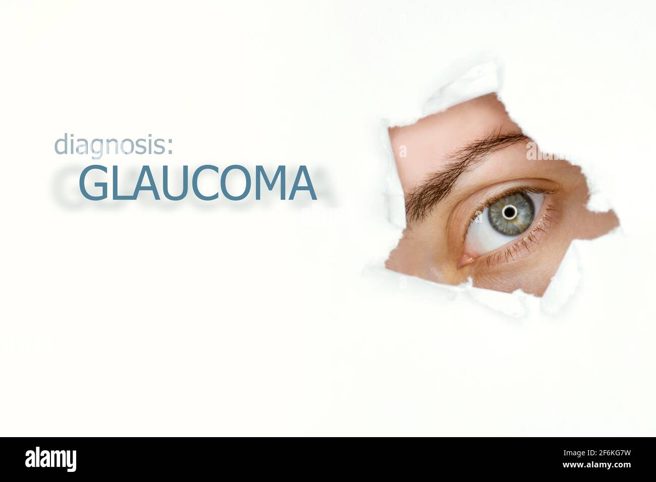 L'œil de la femme regarde par le trou de sarcelle dans le papier, le mot glaucome sur la gauche. Modèle de concept de maladie oculaire. Arrière-plan blanc isolé. Banque D'Images