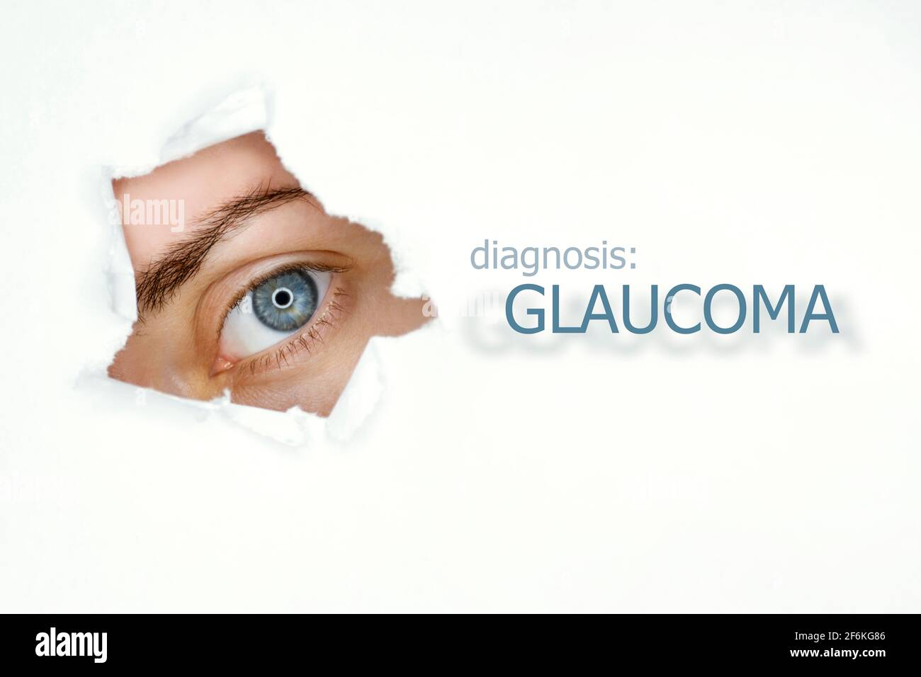 L'œil de la femme regarde par le trou de sarcelle dans le papier, mot glaucome sur la droite. Modèle de concept de maladie oculaire. Arrière-plan blanc isolé. Banque D'Images