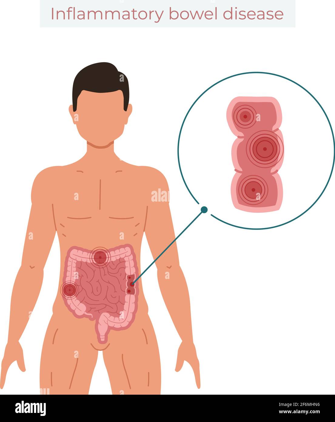 Illustration du vecteur de la maladie inflammatoire de l'intestin isolée sur fond blanc Illustration de Vecteur