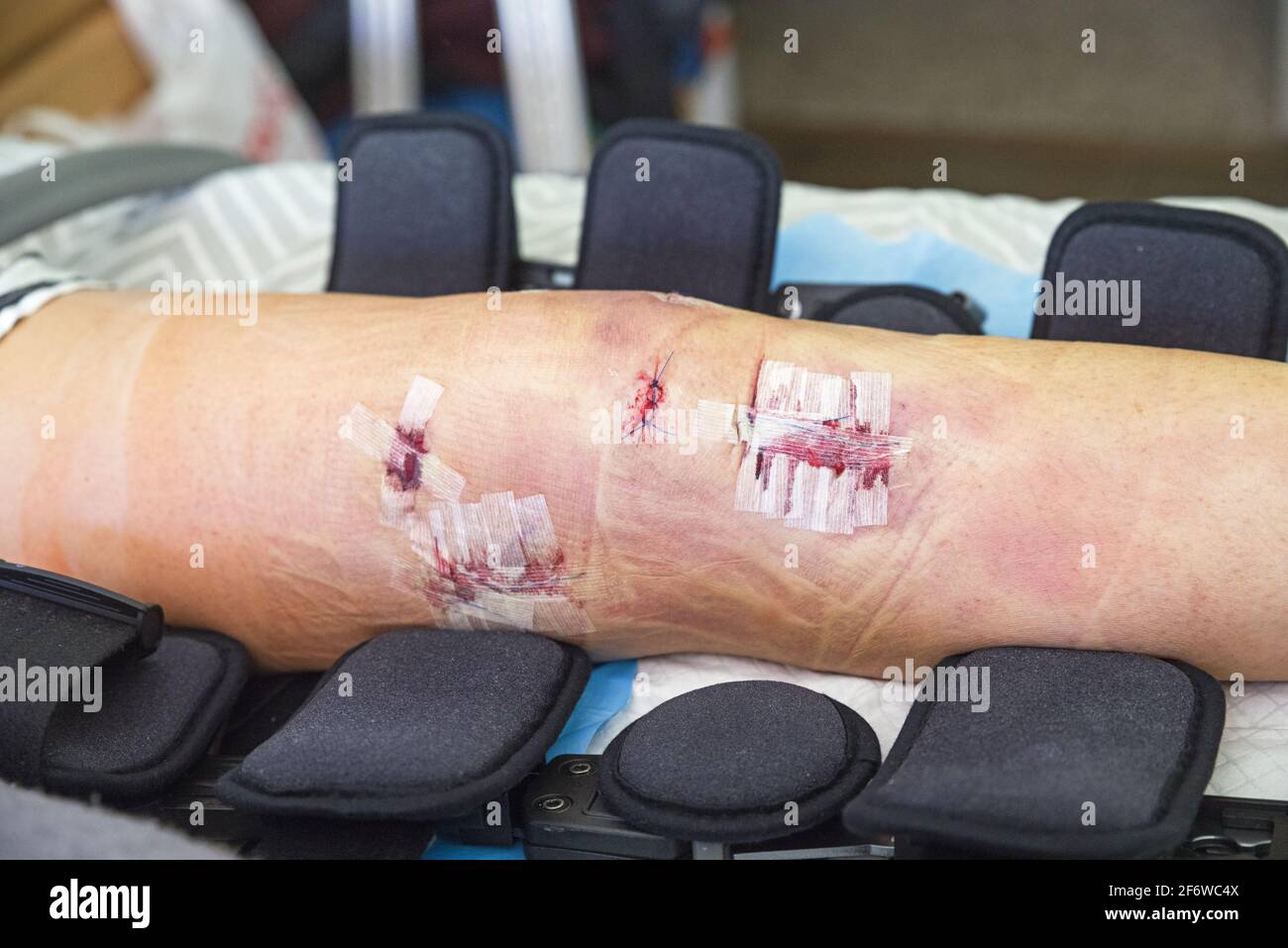 Un genou de l'utérus le lendemain de la reconstruction ACL et MCL chirurgie avec le renfort et les bandages enlevés mais sutures dedans placer Banque D'Images