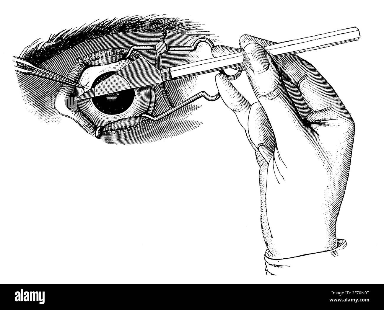 Chirurgie de la cataracte. Illustration du 19e siècle. Allemagne. Arrière-plan blanc. Banque D'Images