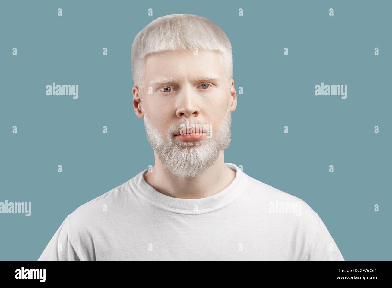 Portrait de l'homme albino en t-shirt posé sur fond turquoise studio. Aspect inhabituel, anomalie de la peau concept Banque D'Images