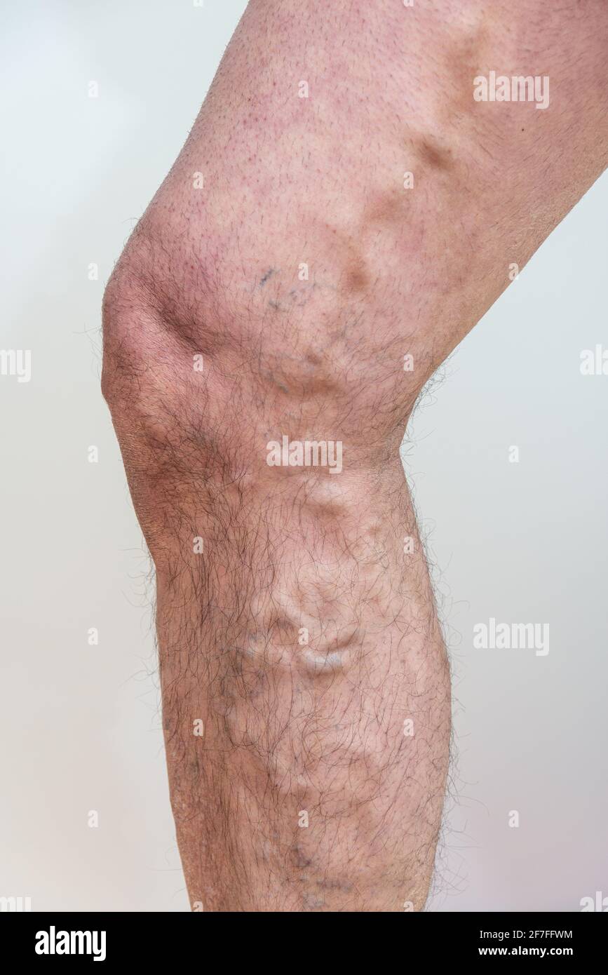 Veine variqueuse sur les jambes mâles âgées sur fond blanc . Banque D'Images