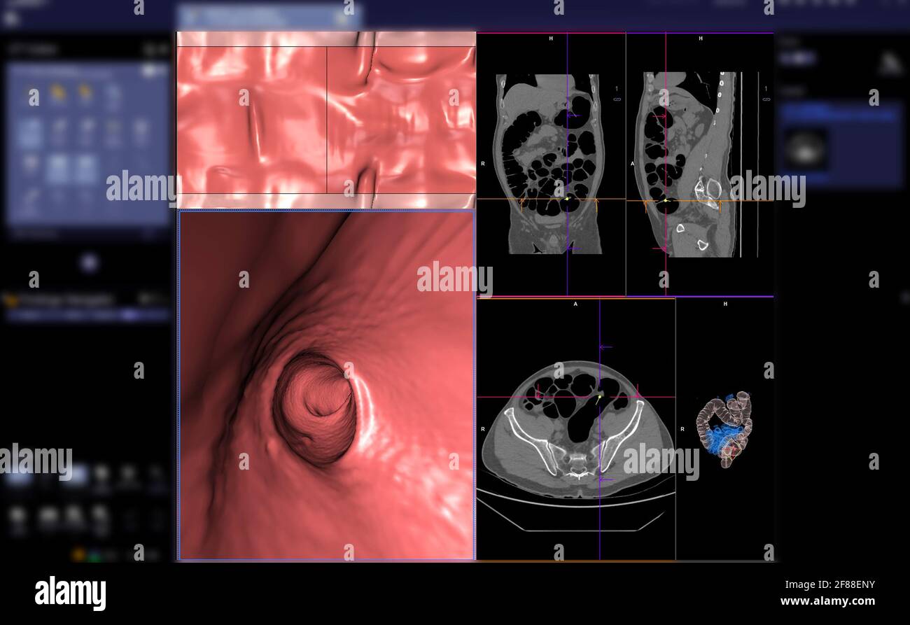 CT Colonography ou CT Scan of Colon axial View vs Coronal View et 3D ...