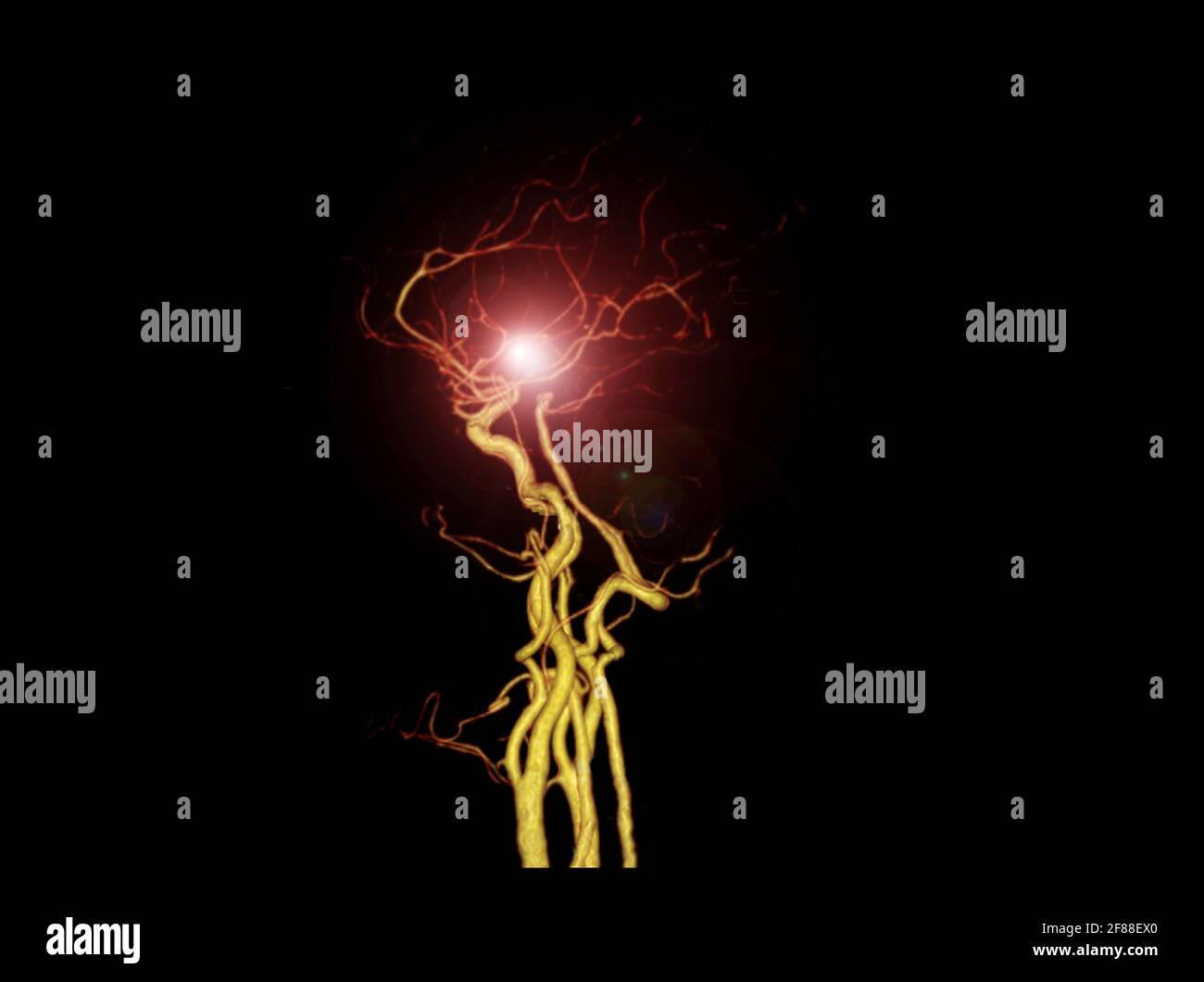 Angiographie TDM CÉRÉBRALE ou TDM cérébrale image 3D de rendu montrant l'artère cérébrale. Banque D'Images