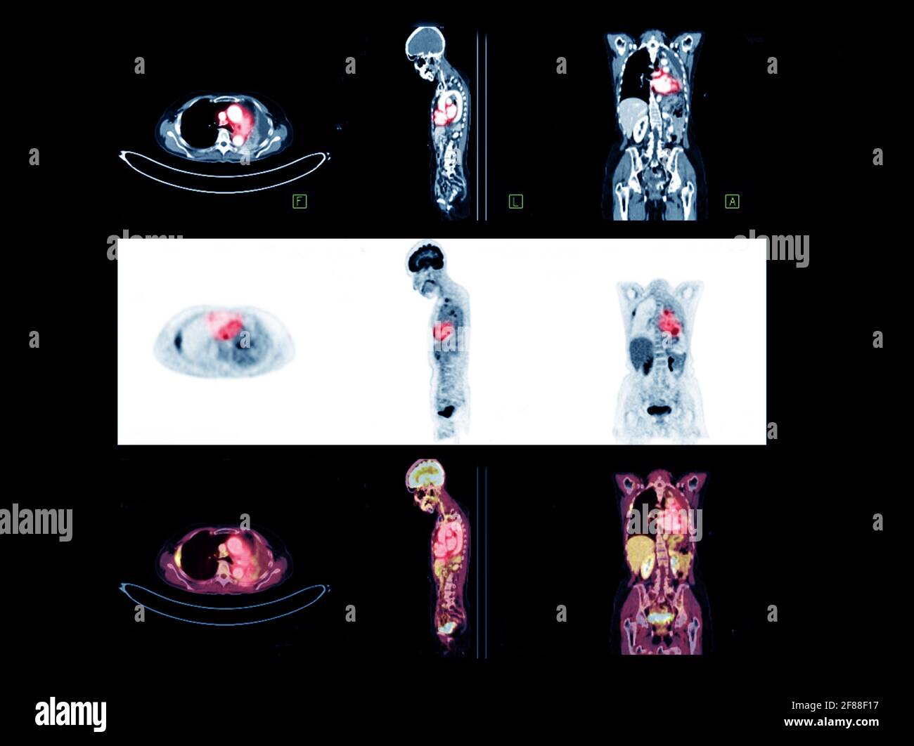 PET Scan image of whole body Comparison Axial , Coronal et Sagittal plan pour détecter la récurrence du cancer après la chirurgie. Concept de technologie médicale. Banque D'Images