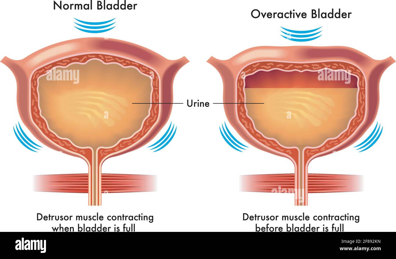 Illustration médicale compare une vessie normale à une vessie hyperactive, avec des annotations. Illustration de Vecteur