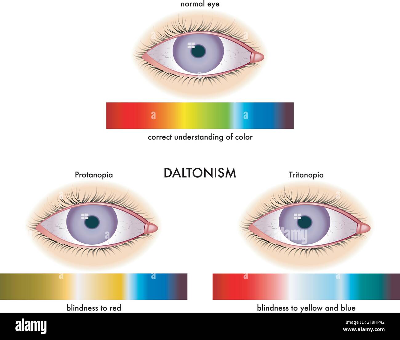 Illustration médicale des symptômes du daltonisme, avec annotations. Illustration de Vecteur