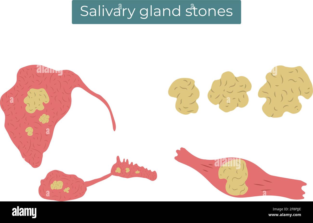 Illustration vectorielle plate de pierres dans les glandes et le conduit parotides, sous-mandibulaires et sublinguaux. Illustration de Vecteur