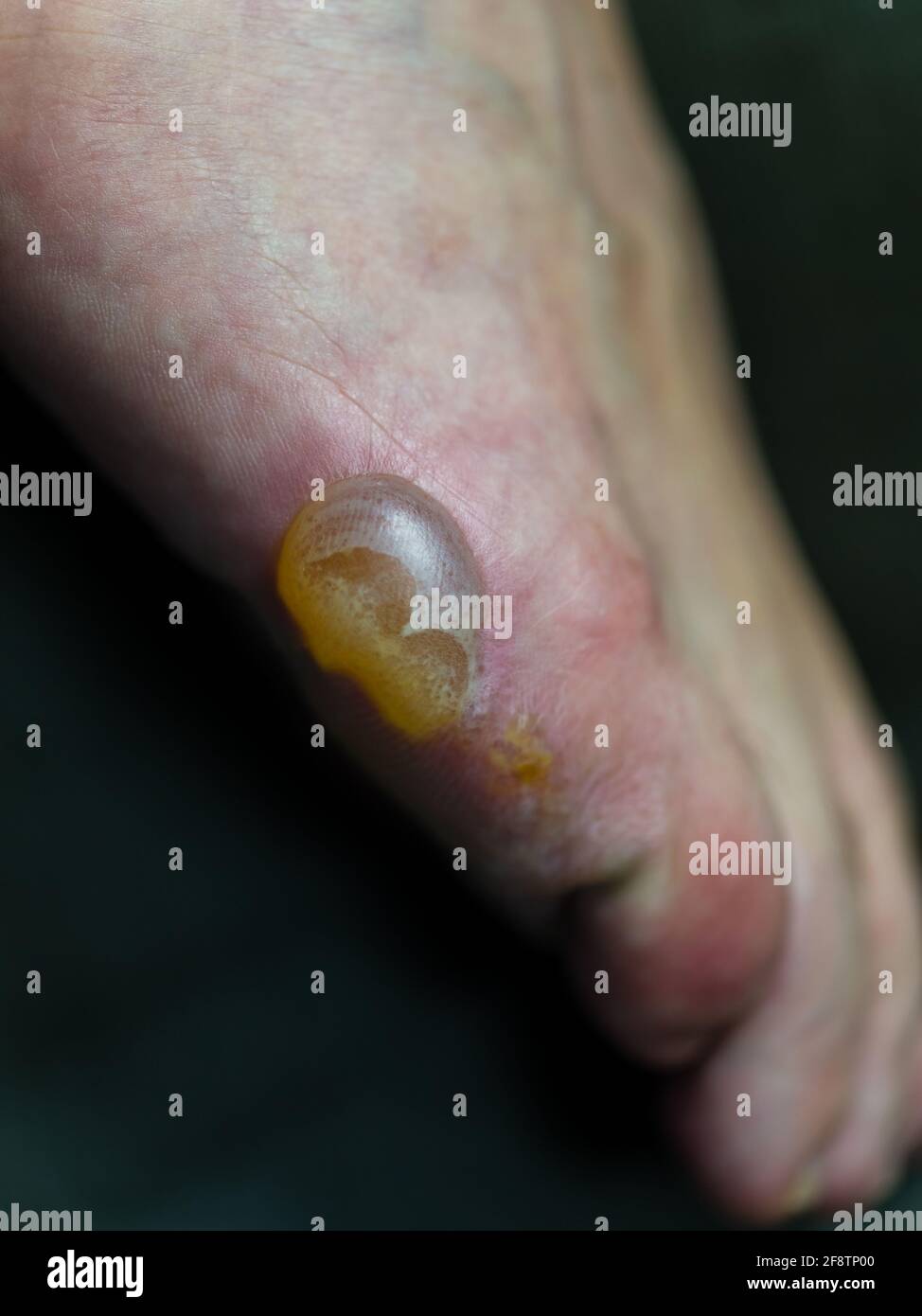 Grand blister et peau écaillage sur le pied de l'eczéma de Pompholyx Banque D'Images