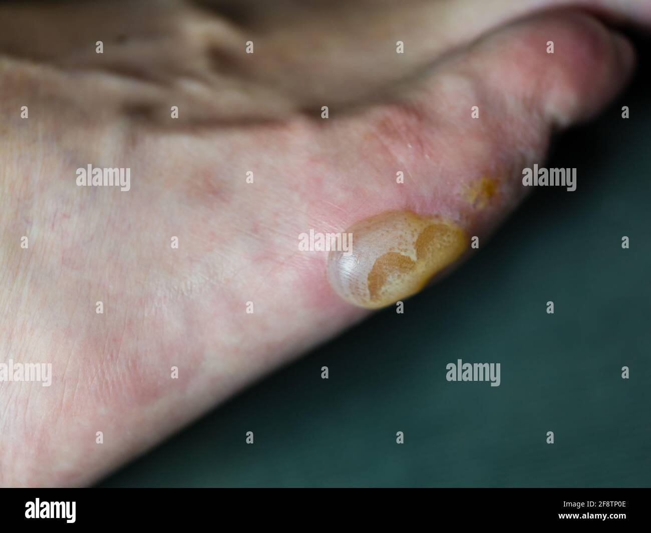 Grand blister et peau écaillage sur le pied de l'eczéma de Pompholyx Banque D'Images