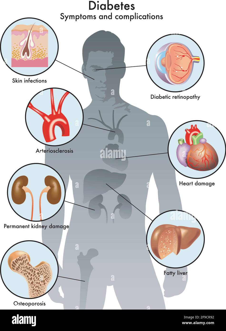 Illustration médicale des symptômes et complications du diabète. Illustration de Vecteur