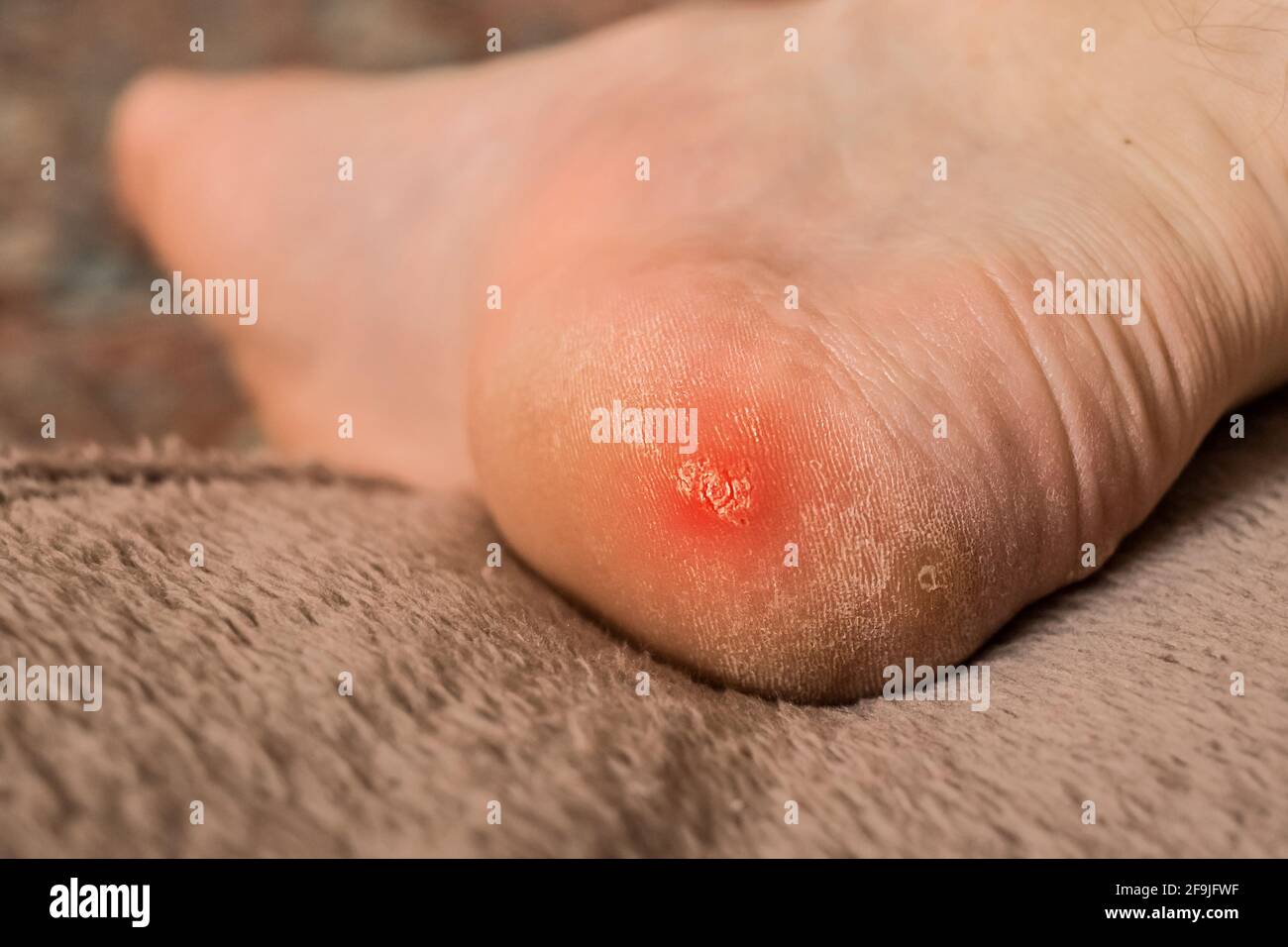 Sécher le mazole sur un talon mâle fissuré. Jambe de l'homme avec cornes, gros plan. Banque D'Images