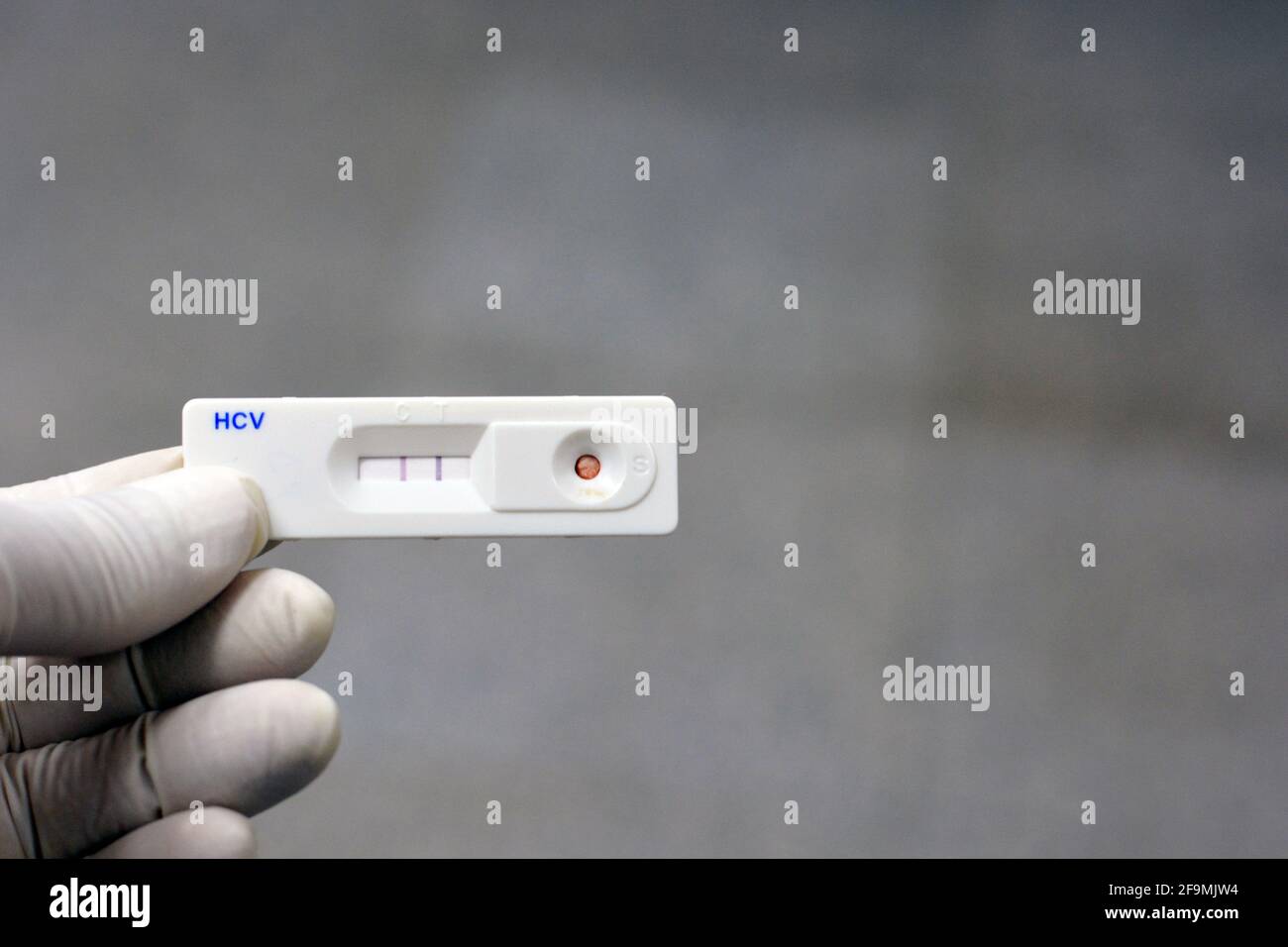 Un résultat positif pour la cassette du kit de test rapide de l'hépatite C qui vérifie les anticorps du virus de l'hépatite c détenus par une main du personnel médical Banque D'Images