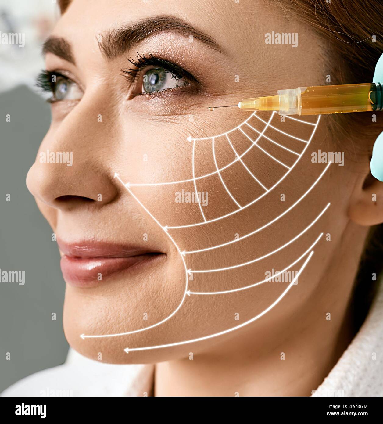 Peau plasmolifante. Femme d'âge moyen avec flèches de levage sur son visage pendant la thérapie au plasma Banque D'Images