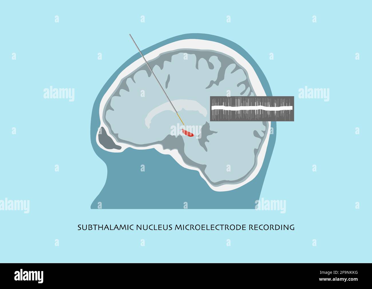 Illustration de l'enregistrement des microélectrodes et des ondes cérébrales enregistrées dans le noyau subthalamique ou le STN pour la chirurgie de la maladie de Parkinson. Illustration de Vecteur