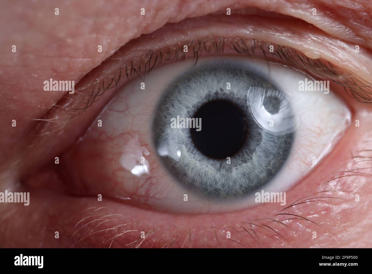 Gros plan de l'œil malade avec des vaisseaux rouges dilatés Banque D'Images