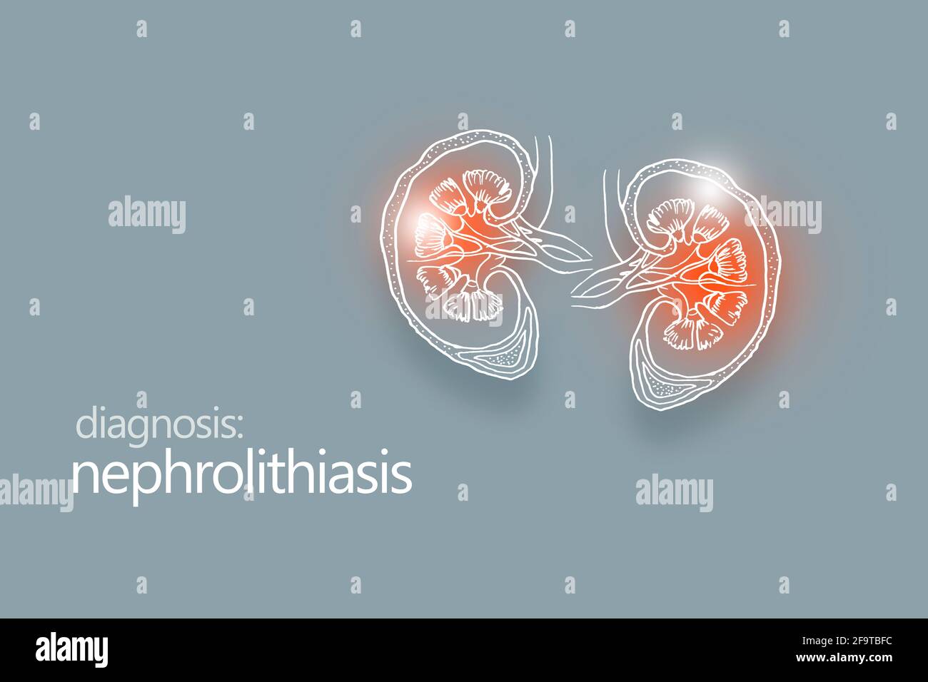 Néphrolithiase maladie des calculs rénaux ou urolithiase. Calculs rénaux ou pierres bloquant l'appareil urinaire.modèle de conception de style minimaliste Banque D'Images
